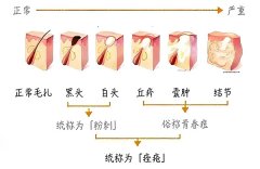 黑头怎么去除最有效？去除黑头最有效的方法